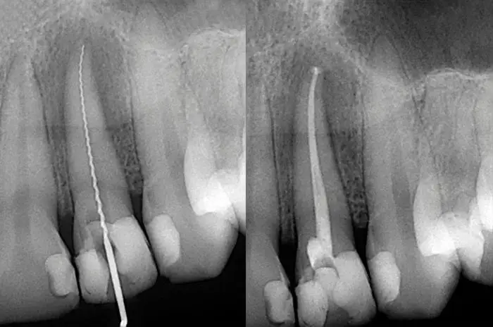 Endodoncia Madrid